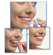 Clear Correct aligners for teeth correction, practiced by Mandeville Dentist Dr. Lisa Landesman