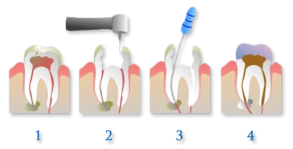 Visual Demonstration of removal and filling of a root canal. Family Dentistry Dr. Lisa Landesman, Camellia Creek Dental 