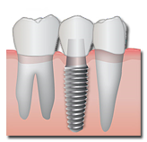 Implant diagram for a missing tooth.